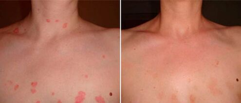 Psoriasi prima e dopo il trattamento con crema Keramin