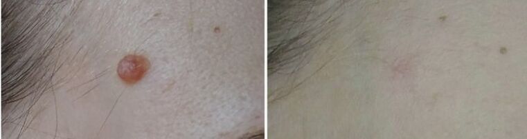 prima e dopo la rimozione del papilloma laser foto 2