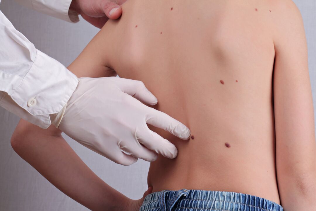 Un dermatologo effettua un esame clinico di un paziente con papillomi sul corpo