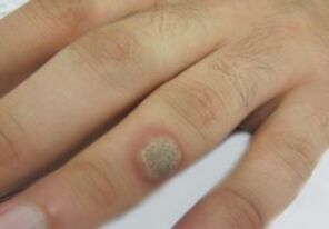 Papilloma sul pennello