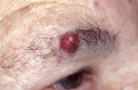 Papilloma sulle sopracciglia