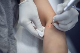 Trattamento laser