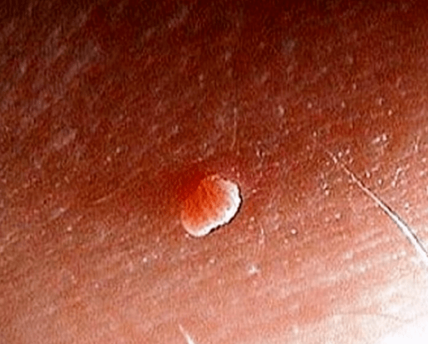 Papilloma sul corpo