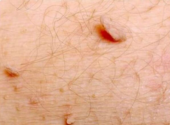 Papillomi affilati sul corpo umano