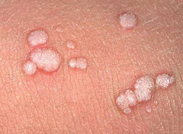Papillomi sul corpo umano