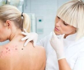 Sintomi del virus del papilloma umano