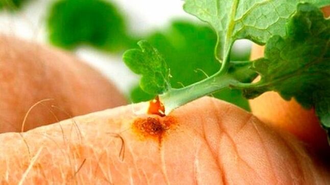 Applicazione del succo di celidonia su una verruca