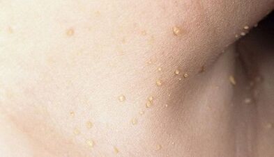 rischio di sviluppare papillomatosi sul collo