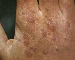 cause delle verruche