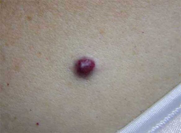 neo rosso sul corpo