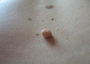 Il papilloma è una crescita sulla superficie della pelle
