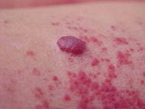 Macchie rosse attorno al papilloma