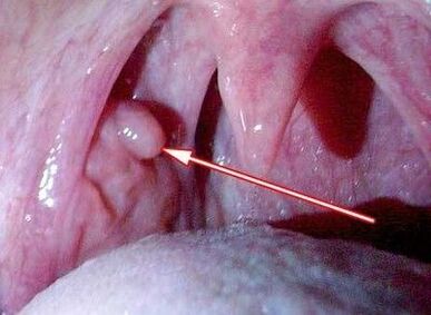 Papilloma alla gola