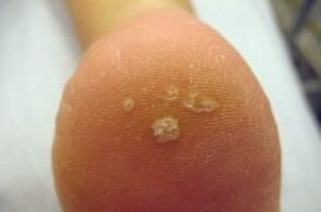 Verruca plantare