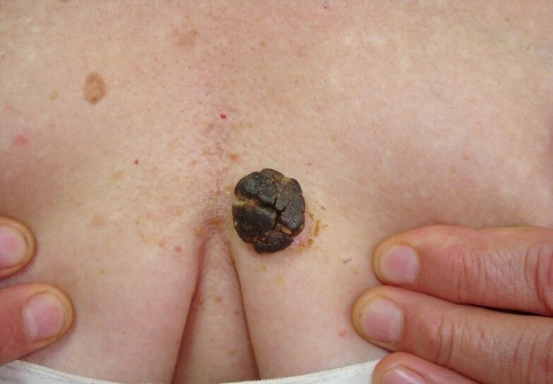 cheratoma sul corpo umano