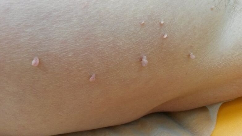papillomi sul corpo umano