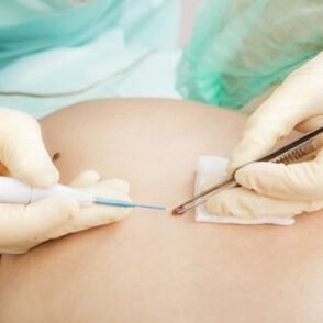 rimozione del papilloma da parte di un chirurgo