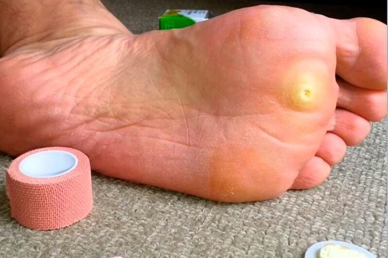 verruca plantare sul piede