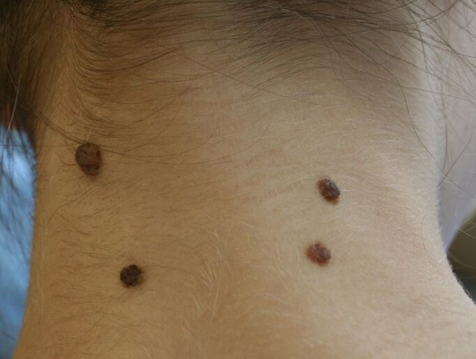 che aspetto hanno i papillomi sul collo