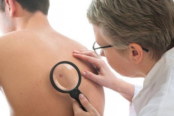 il medico esamina il papilloma sulla schiena