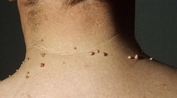 papilloma filiforme sul collo