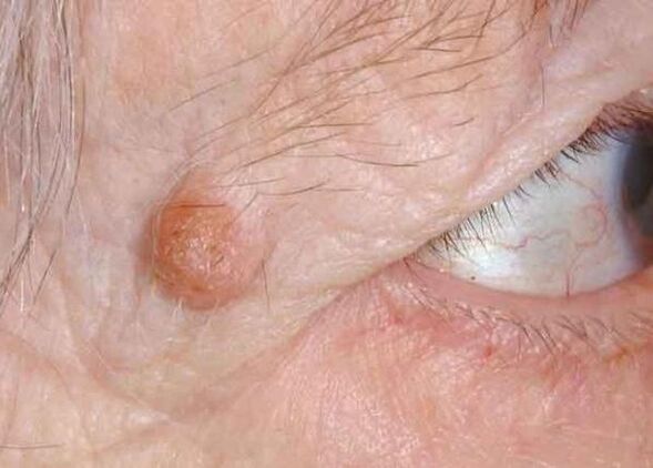 papilloma sulla palpebra