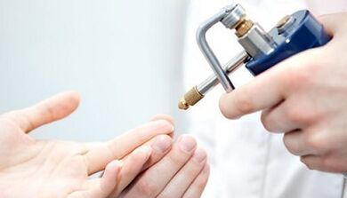 Criodestruzione come metodo per il trattamento delle verruche