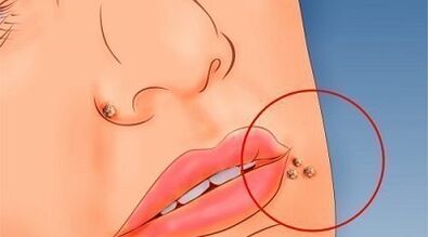 Le ragioni dell'apparizione delle verruche
